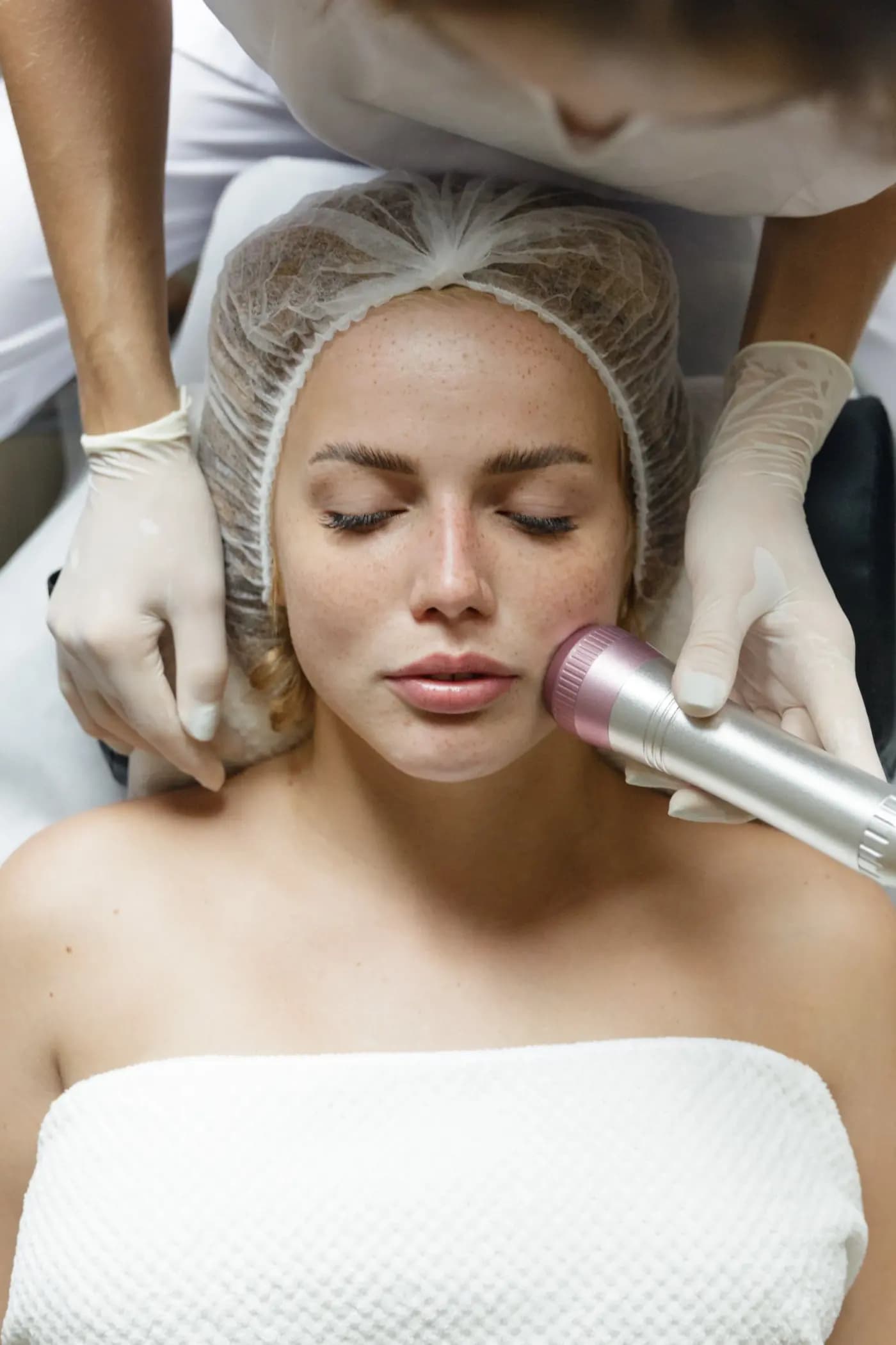 Face SMAS lifting — Before